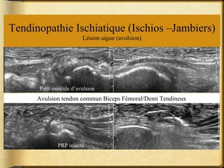 Tendinopathie Ischiatique (Ischios –Jambiers) 
Lésion aigue (avulsion) 
Petit ossicule d’avulsion 
Avulsion tendon commun Biceps Fémoral/Demi Tendineux 
PRP injecté 
 