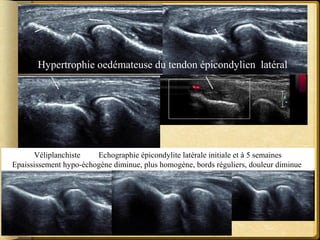 Hypertrophie oedémateuse du tendon épicondylien latéral 
Véliplanchiste Echographie épicondylite latérale initiale et à 5 semaines 
Epaississement hypo-échogène diminue, plus homogène, bords réguliers, douleur diminue 
 