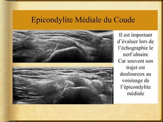 Epicondylite Médiale du Coude 
Il est important 
d’évaluer lors de 
l’échographie le 
nerf ulnaire 
Car souvent son 
trajet est 
douloureux au 
voisinage de 
l’épicondylite 
médiale 
 