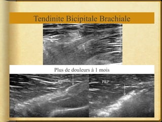 Tendinite Bicipitale Brachiale 
Plus de douleurs à 1 mois 
aiguille PRP 
 