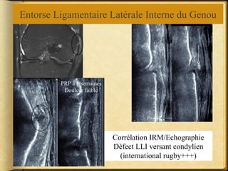 Entorse Ligamentaire Latérale Interne du Genou 
PRP à 3 semaines 
Douleur faible 
Corrélation IRM/Echographie 
Défect LLI versant condylien 
(international rugby+++) 
 