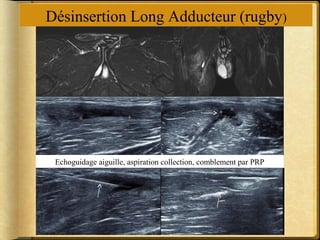 Désinsertion Long Adducteur (rugby) 
Echoguidage aiguille, aspiration collection, comblement par PRP 
 