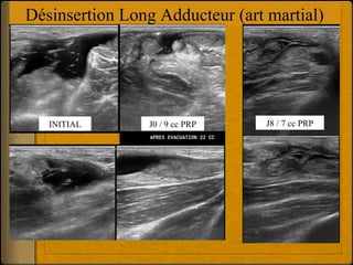 Désinsertion Long Adducteur (art martial) 
INITIAL J0 / 9 cc PRP J8 / 7 cc PRP 
 