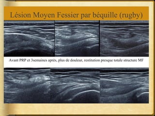 Lésion Moyen Fessier par béquille (rugby) 
Avant PRP et 3semaines après, plus de douleur, restitution presque totale structure MF 
 