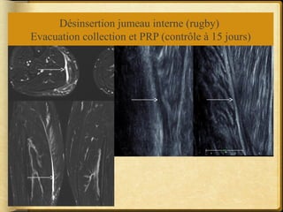Désinsertion jumeau interne (rugby) 
Evacuation collection et PRP (contrôle à 15 jours) 
 