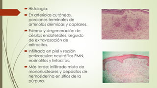  Histología:
 En arteriolas cutáneas,
porciones terminales de
arteriolas dérmicas y capilares.
 Edema y degeneración de
células endoteliales, seguido
de extravasación de
eritrocitos.
 Infiltrado en piel y región
perivascular: neutrófilos PMN,
eosinófilos y linfocitos.
 Más tarde: infiltrado mixto de
mononucleares y depósitos de
hemosiderina en sitios de la
púrpura.
 