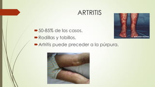 ARTRITIS
50-85% de los casos.
Rodillas y tobillos.
Artritis puede preceder a la púrpura.
 