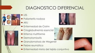 DIAGNOSTICO DIFERENCIAL
 LES
 Poliarteritis nodosa
 ARJ
 Enfermedad de Crohn
 Crioglobulinemia esencial
 Eritema multiforme
 Dermatomiositis
 Granulomatosis de Wegener
 Fiebre reumática
 Enfermedad mixta del tejido conjuntivo
 