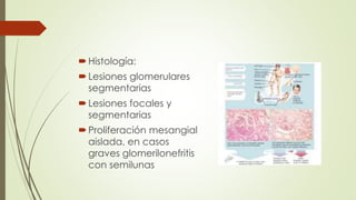 Histología:
Lesiones glomerulares
segmentarias
Lesiones focales y
segmentarias
Proliferación mesangial
aislada, en casos
graves glomerilonefritis
con semilunas
 