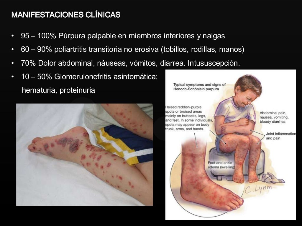 Púrpura de Schönlein-Henoch