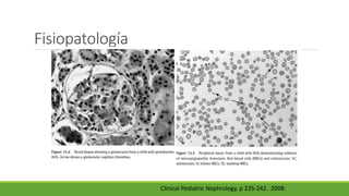 Fisiopatología
Clinical Pediatric Nephrology, p 235-242. 2008.
 