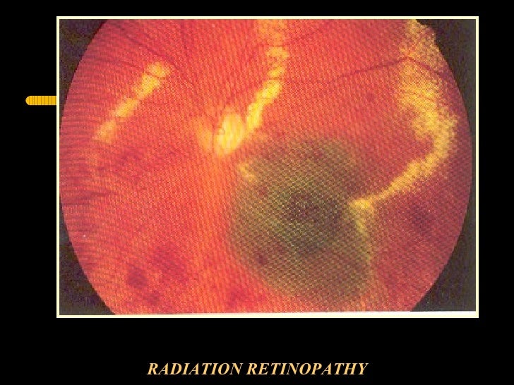 Radiation Injuries To Eye