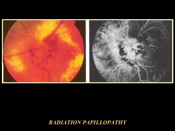 Radiation Injuries To Eye