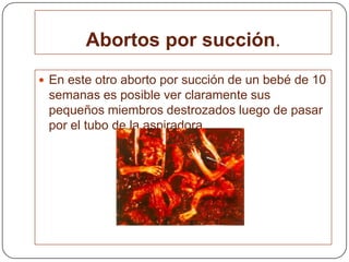 Abortos por succión.En este otro aborto por succión de un bebé de 10 semanas es posible ver claramente sus pequeños miembros destrozados luego de pasar por el tubo de la aspiradora.