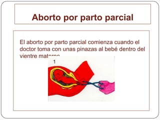 Aborto por parto parcial El aborto por parto parcial comienza cuando el doctor toma con unas pinazas al bebé dentro del vientre materno.