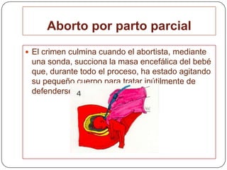 Aborto por parto parcial El crimen culmina cuando el abortista, mediante una sonda, succiona la masa encefálica del bebé que, durante todo el proceso, ha estado agitando su pequeño cuerpo para tratar inútilmente de defenderse.