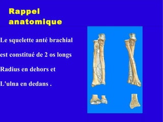 fractures diaphysaires des os de l'avant bras