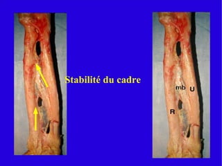 fractures diaphysaires des os de l'avant bras
