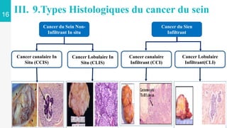 16
III. 9.Types Histologiques du cancer du sein
Cancer du Sein Non-
Infiltrant In situ
Cancer Lobulaire In
Situ (CLIS)
Cancer canalaire In
Situ (CCIS)
Cancer canalaire
Infiltrant (CCI)
Cancer Lobulaire
Infiltrant(CLI)
Cancer du Sien
Infiltrant
 