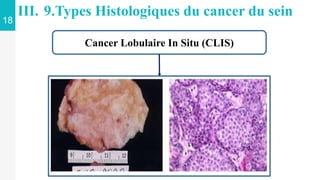 18
III. 9.Types Histologiques du cancer du sein
Cancer Lobulaire In Situ (CLIS)
 
