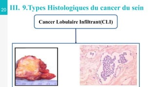 20 III. 9.Types Histologiques du cancer du sein
Cancer Lobulaire Infiltrant(CLI)
 