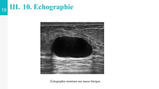 19
III. 10. Echographie
Échographie montrant une masse bénigne
 
