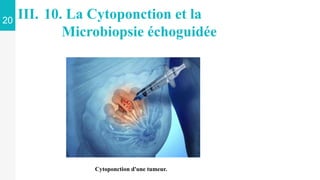 20
III. 10. La Cytoponction et la
Microbiopsie échoguidée
Cytoponction d'une tumeur.
 