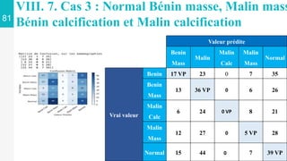 81
VIII. 7. Cas 3 : Normal Bénin masse, Malin mass
Bénin calcification et Malin calcification
Valeur prédite
Benin
Mass
Malin
Malin
Calc
Malin
Mass
Normal
Vrai valeur
Benin 17 VP 2236 0 7 35
Benin
Mass
3131 36 VP 0 6 26
Malin
Calc
6 24 0 VP 8 21
Malin
Mass
12 27 0 5 VP 28
Normal 15 44 750 VP 7 39 VP
 