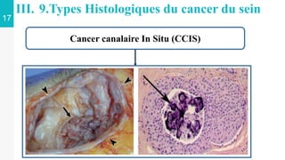 17
III. 9.Types Histologiques du cancer du sein
Cancer canalaire In Situ (CCIS)
 
