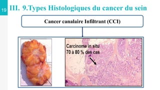 19 III. 9.Types Histologiques du cancer du sein
Cancer canalaire Infiltrant (CCI)
 