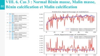 80
VIII. 6. Cas 3 : Normal Bénin masse, Malin masse,
Bénin calcification et Malin calcification
 