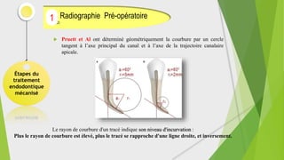  Pruett et Al ont déterminé géométriquement la courbure par un cercle
tangent à l’axe principal du canal et à l’axe de la trajectoire canalaire
apicale.
Étapes du
traitement
endodontique
mécanisé
Radiographie Pré-opératoire
(2)
1
Le rayon de courbure d'un tracé indique son niveau d'incurvation :
Plus le rayon de courbure est élevé, plus le tracé se rapproche d'une ligne droite, et inversement.
 
