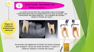 Cette relocalisation se fait toujours en
appuyant sur les parois externes du canal
dites paroi de sécurité et non pas les
parois internes à cause du risque de
perforation
La cavité d’accès doit être relocalisée avant d’envisager
l’instrumentation pour sa préparation et sa mise en forme , par
l’élimination des petits éperons « les triangles de Schilder »
situés à l’entrée du canal ;
Étapes du
traitement
endodontique
mécanisé
Cavité d’accès+ Relocalisation des
entrées canalaires (1)
5
On prendra soin également d’utiliser les inserts ultrasons
pour préparer l’accès aux forets de Gates n°3 puis n°4
utilisé en rotation à l’entrée des canaux
 
