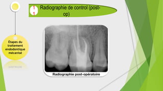 Étapes du
traitement
endodontique
mécanisé
Radiographie de control (post-
op)
1
1
 
