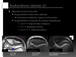 Améliorations récentes (1)
            Approche ultra-structurale
              Augmentation résolution spatiale
                 Striations radiaires, aspect multicouches
              Augmentation intensité du champ magnétique
                   ○ 1,5 T = majorité des imageurs
                   ○ 3 T = quelques centres
                   ○ 6 à 7 T = expérimentation




                                  2010                      2010
1995                         Routine clinique           Expérimental
           EG T2 TRA               DP FS TSE TRA   DP FS TSE TRA 0.1x0.1x3mm à 7T
           5mm à 1 T               3mm à 1.5 T     Image SIEMENS
 