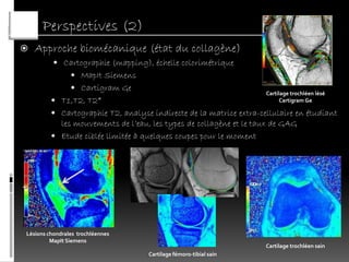 Perspectives (2)
   Approche biomécanique (état du collagène)
           Cartographie (mapping), échelle colorimétrique
                 MapIt Siemens
                 Cartigram Ge
                                                                    Cartilage trochléen lésé
          T1,T2, T2*                                                     Cartigram Ge

          Cartographie T2, analyse indirecte de la matrice extra-cellulaire en étudiant
           les mouvements de l’eau, les types de collagène et le taux de GAG
          Etude ciblée limitée à quelques coupes pour le moment




Lésions chondrales trochléennes
         MapIt Siemens
                                                                    Cartilage trochléen sain
                                   Cartilage fémoro-tibial sain
 