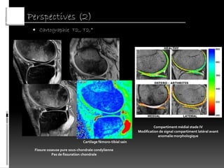 Perspectives (2)
  Cartographie T2,, T2,*




                                                                     Compartiment médial stade IV
                                                            Modification de signal compartiment latéral avant
                                                                        anomalie morphologique
                             Cartilage fémoro-tibial sain

 Fissure osseuse pure sous-chondrale condylienne
            Pas de fissuration chondrale
 