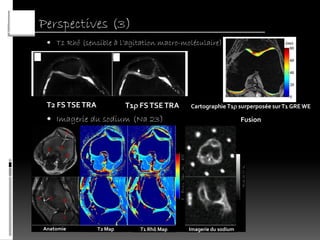 Perspectives (3)
  T1 Rhô (sensible à l’agitation macro-moléculaire)




 T2 FS TSE TRA            T1 FS TSE TRA   Cartographie T1 surperposée sur T1 GRE WE

  Imagerie du sodium (Na 23)                                   Fusion




Anatomie         T2 Map      T1 Rhô Map    Imagerie du sodium
 