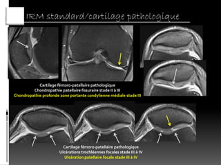 IRM standard/cartilage pathologique




            Cartilage fémoro-patellaire pathologique
         Chondropathie patellaire fissuraire stade II à III
Chondropathie profonde zone portante condylienne médiale stade III




                         Cartilage fémoro-patellaire pathologique
                       Ulcérations trochléennes focales stade III à IV
                          Ulcération patellaire focale stade III à IV
 