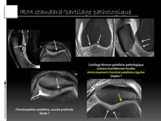 IRM standard/cartilage pathologique




                                             Cartilage fémoro-patellaire pathologique
                                                    Lésions trochléennes focales
                                            Amincissement chondral patellaire régulier
                                                              Stades ?




Chondropathie patellaire, couche profonde
                Stade ?
 