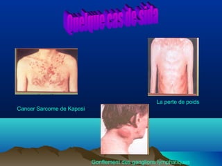 Cancer Sarcome de Kaposi

La perte de poids

Gonflement des ganglions lymphatiques

 