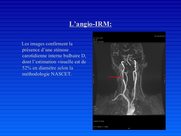 Hypoplasie Du Segment A1 De L'artère Cérébrale Antérieure Droite