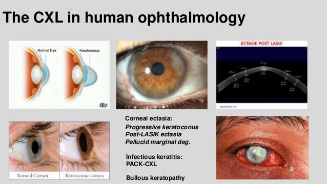 corneal ectasia
