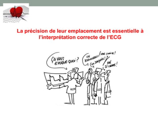 La précision de leur emplacement est essentielle à
l’interprétation correcte de l’ECG
 