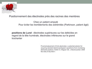 Positionnement des électrodes près des racines des membres
Chez un patient amputé
Pour éviter les tremblements des extrémités (Parkinson, patient âgé)
positions de Lund : électrodes supérieures sur les deltoïdes en
regard de la tête humérale, électrodes inférieures sur le grand
trochanter
Proximal placement of limb electrodes: a potential solution for
acquiring standard electrocardiogram waveforms from monitoring
electrode positions. Pahlm O, Wagner GS. J Electrocardiol. 2008
Nov-Dec;41(6):454-7.
 