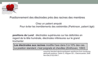 Positionnement des électrodes près des racines des membres
Chez un patient amputé
Pour éviter les tremblements des extrémités (Parkinson, patient âgé)
positions de Lund : électrodes supérieures sur les deltoïdes en
regard de la tête humérale, électrodes inférieures sur le grand
trochanter
Proximal placement of limb electrodes: a potential solution for
acquiring standard electrocardiogram waveforms from monitoring
electrode positions. Pahlm O, Wagner GS. J Electrocardiol. 2008
Nov-Dec;41(6):454-7.
Les électrodes aux racines modifie l'axe dans 5 à 10% des cas.
La position standard, c'est poignets et chevilles (Einthoven, 1893)
 