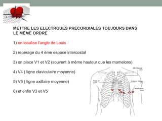 METTRE LES ELECTRODES PRECORDIALES TOUJOURS DANS
LE MÊME ORDRE
1) on localise l'angle de Louis
2) repérage du 4 ème espace intercostal
3) on place V1 et V2 (souvent à même hauteur que les mamelons)
4) V4 ( ligne claviculaire moyenne)
5) V6 ( ligne axillaire moyenne)
6) et enfin V3 et V5
 