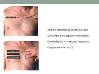 Après le repérage de l’angle de Louis
On compte trois espaces intercostaux
On est dans le 4ème espace intercostal
On positionne V1 et V2
 