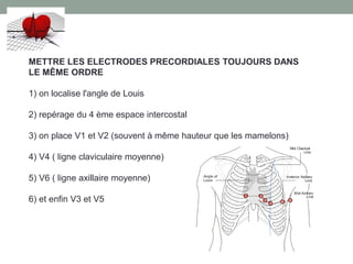 METTRE LES ELECTRODES PRECORDIALES TOUJOURS DANS
LE MÊME ORDRE
1) on localise l'angle de Louis
2) repérage du 4 ème espace intercostal
3) on place V1 et V2 (souvent à même hauteur que les mamelons)
4) V4 ( ligne claviculaire moyenne)
5) V6 ( ligne axillaire moyenne)
6) et enfin V3 et V5
 