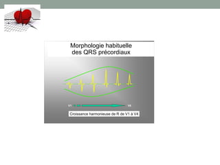 V1V1 V6V6
Morphologie habituelle
des QRS précordiaux
Croissance harmonieuse de R de V1 à V4
 